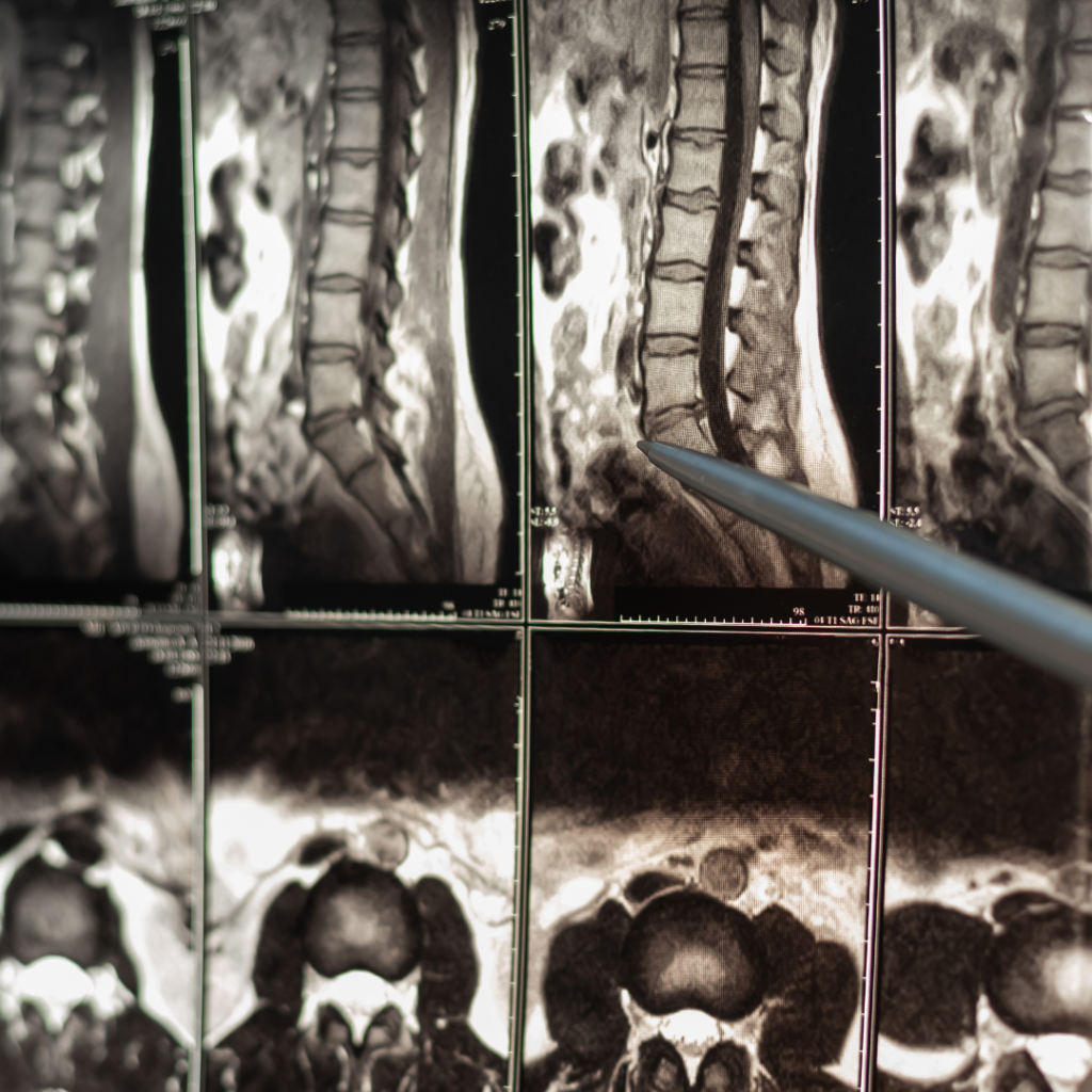 Prolozone Therapy HICC International